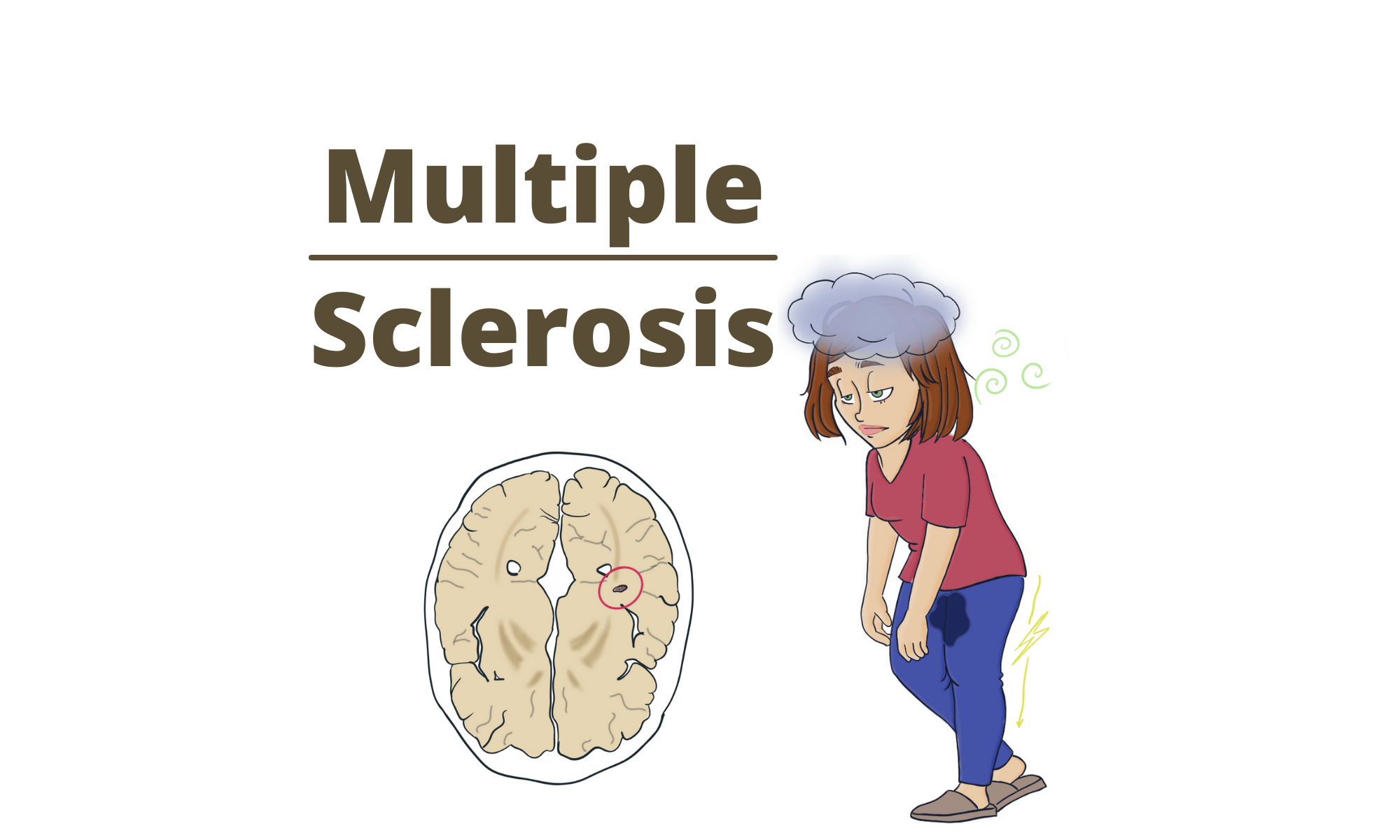 Multiple Sclerosis Symptoms Diagnosis And Treatment Pro Doctor