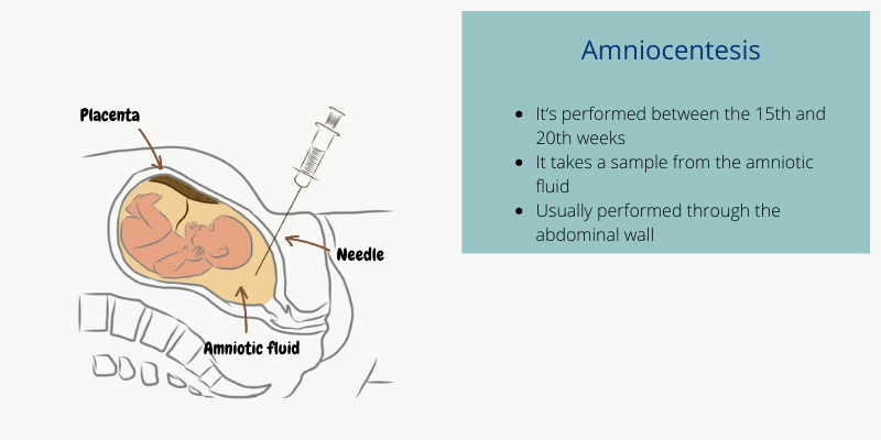 Amniocentesis: a needle through your abdominal wall