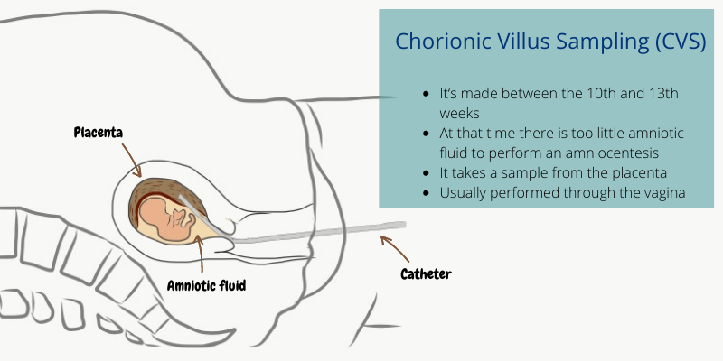 Chorionic Villus Sampling: a catheter through your vagina