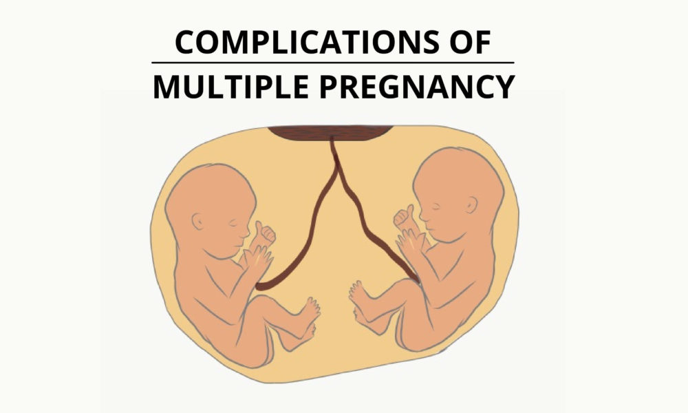 Main 10 Complications Of Multiple Pregnancy - Pro Doctor