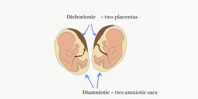 Multiple pregnancy in which two fetuses have two amniotic sacs and placentas