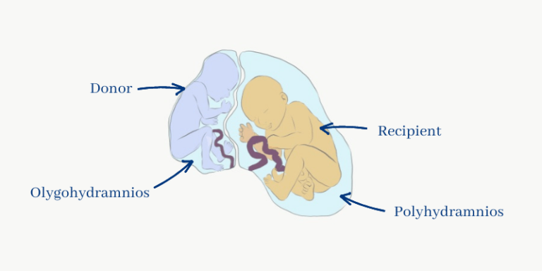 Main 10 Complications Of Multiple Pregnancy - Pro Doctor