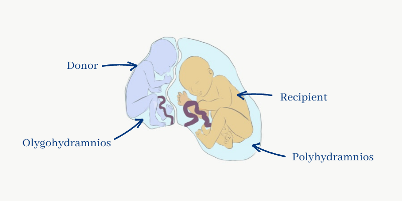 Two fetuses suffering a twin to twin transfusion syndrome, a complication of multiple pregnancies