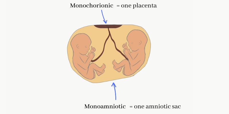 Multiple pregnancy in which two fetuses are sharing a placenta and amniotic sac