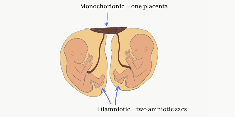 Multiple pregnancy in which two fetuses are sharing one placenta each with his own amniotic sac