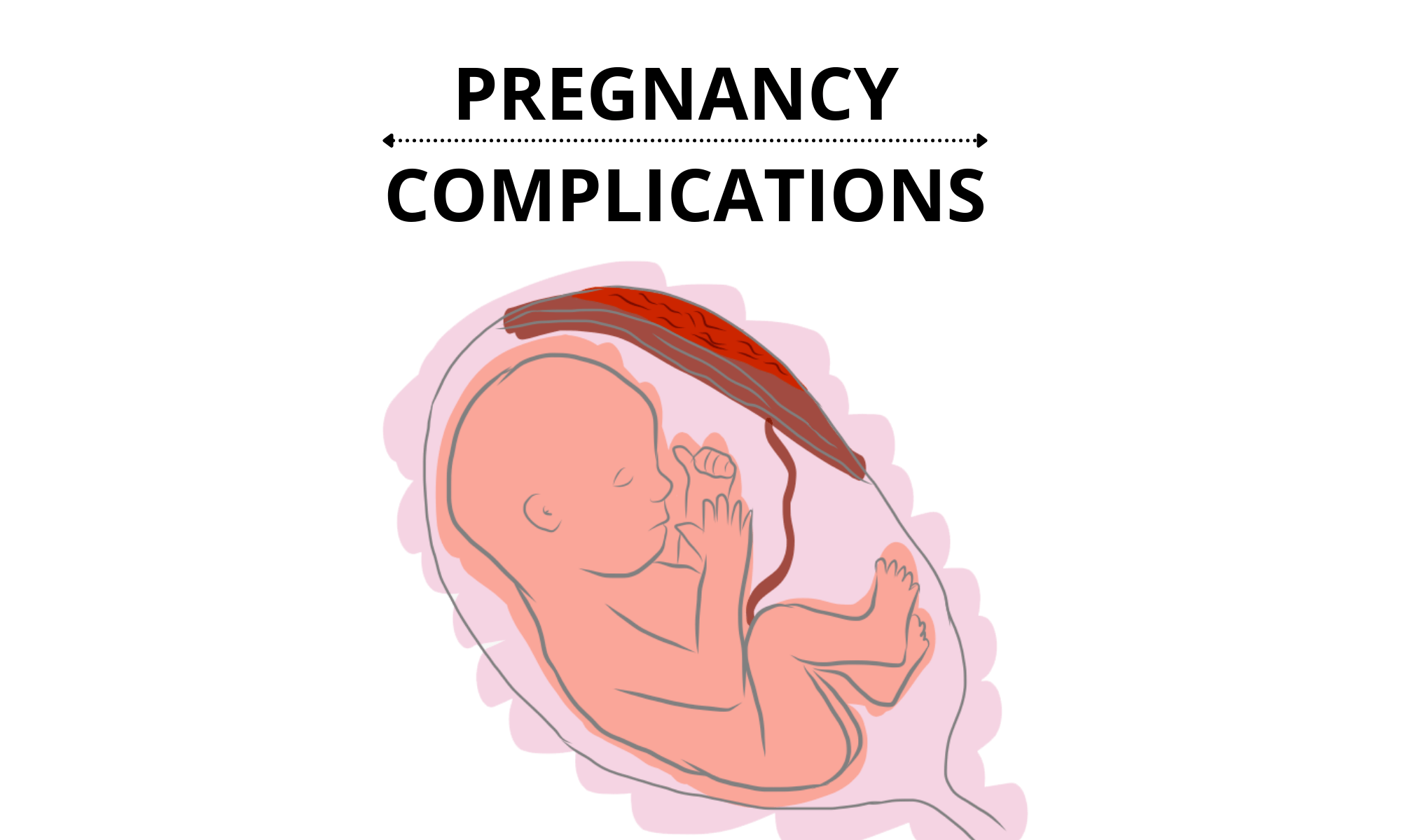 Pregnancy Complications When Things Go Wrong Pro Doctor 