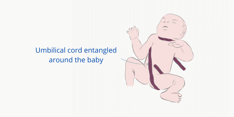 Baby suffering cord entanglement