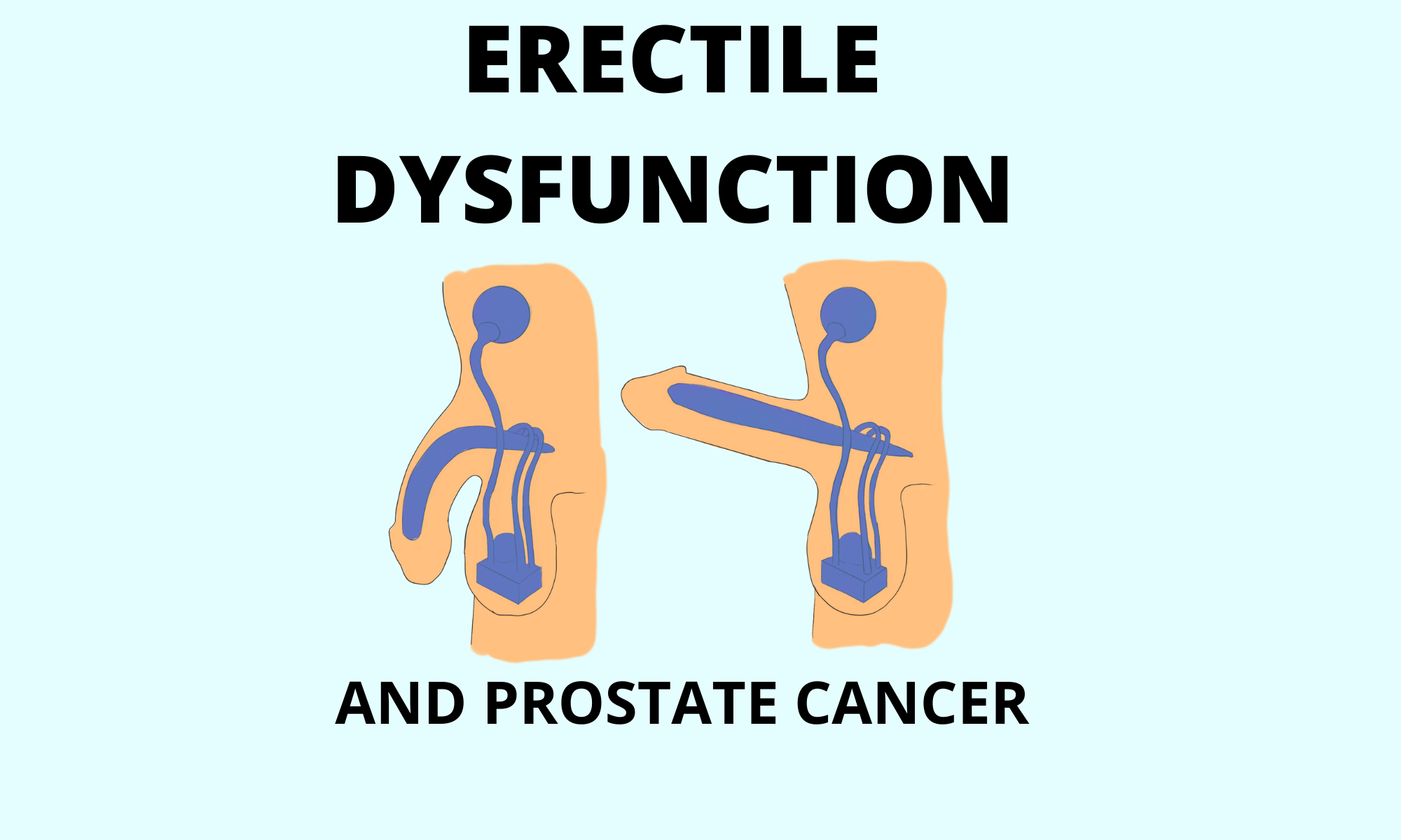 Erectile Dysfunction And Prostate Cancer How To Treat It Pro doctor