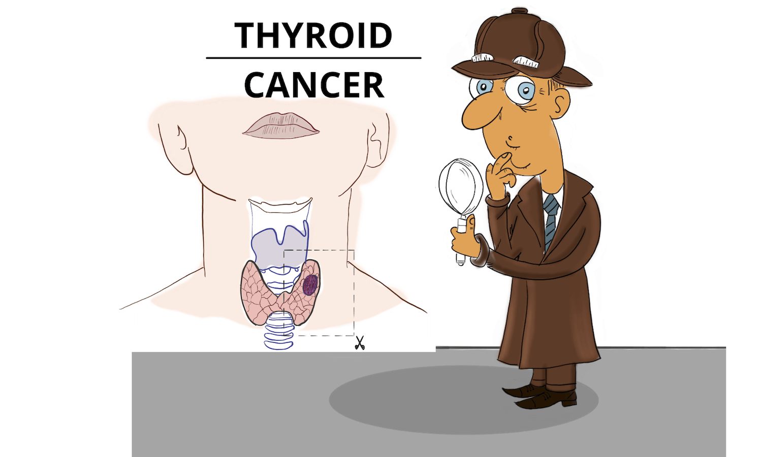 Thyroid Cancer: A Nodule That Should Worry You - Pro doctor