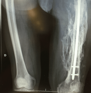 Femoral Fractures: No Time To Lose - Pro doctor