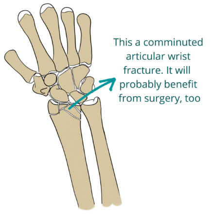 Wrist Fractures (Distal Radius Fractures) - Pro doctor