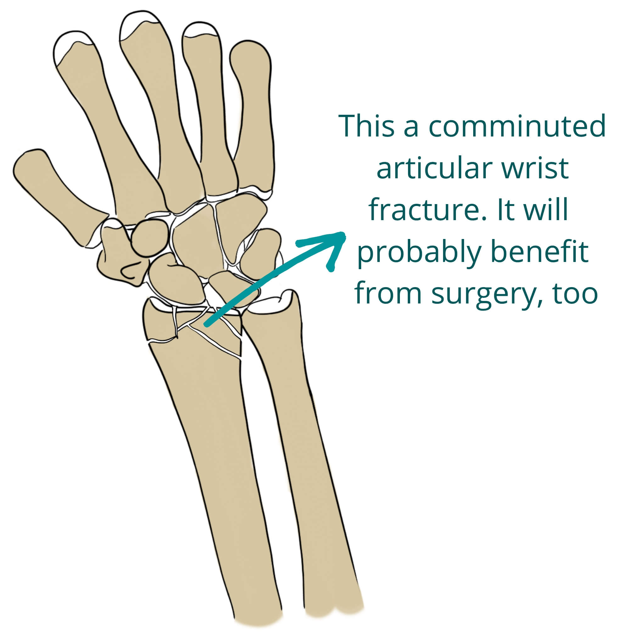 Types Of Wrist Fractures
