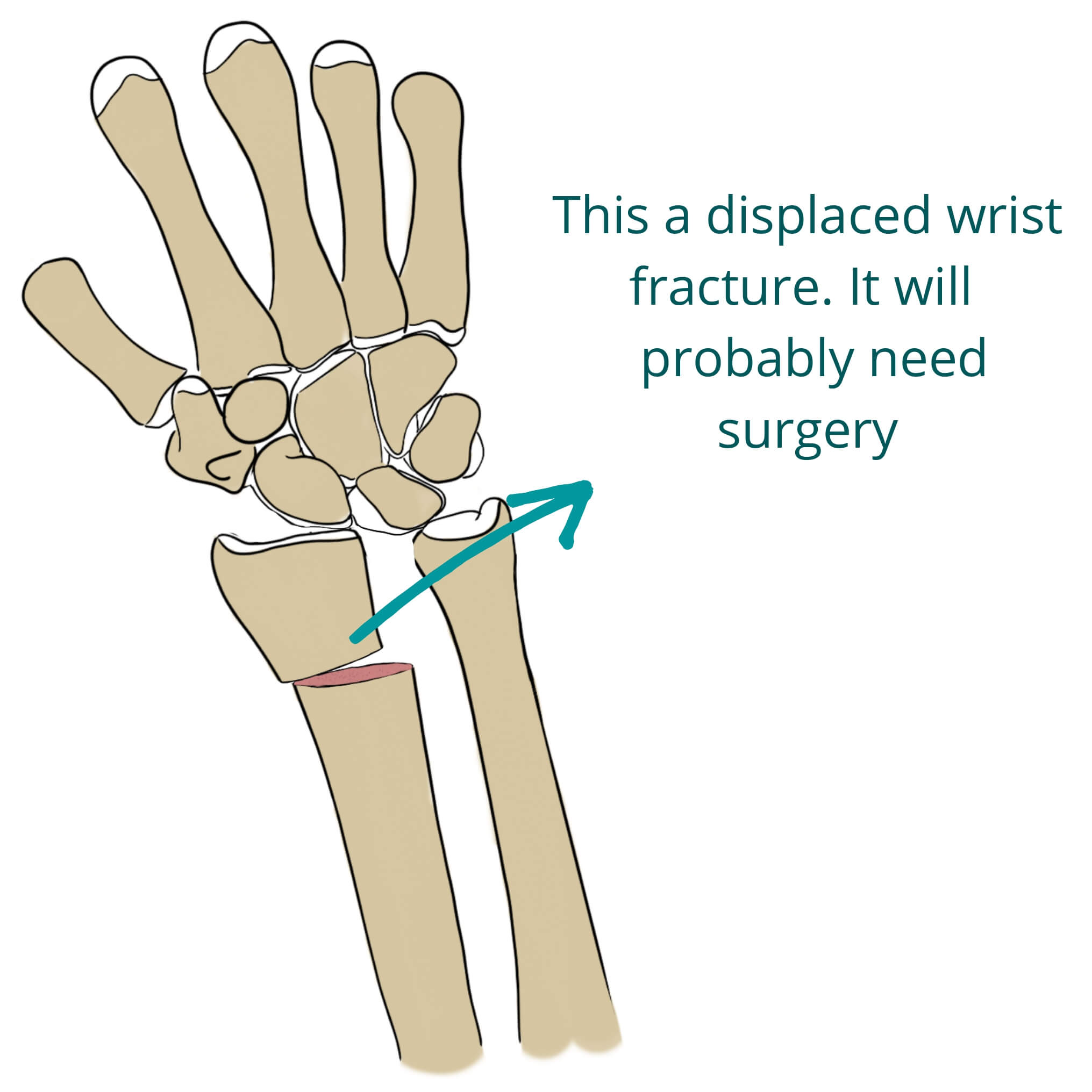 Types Of Wrist Fractures
