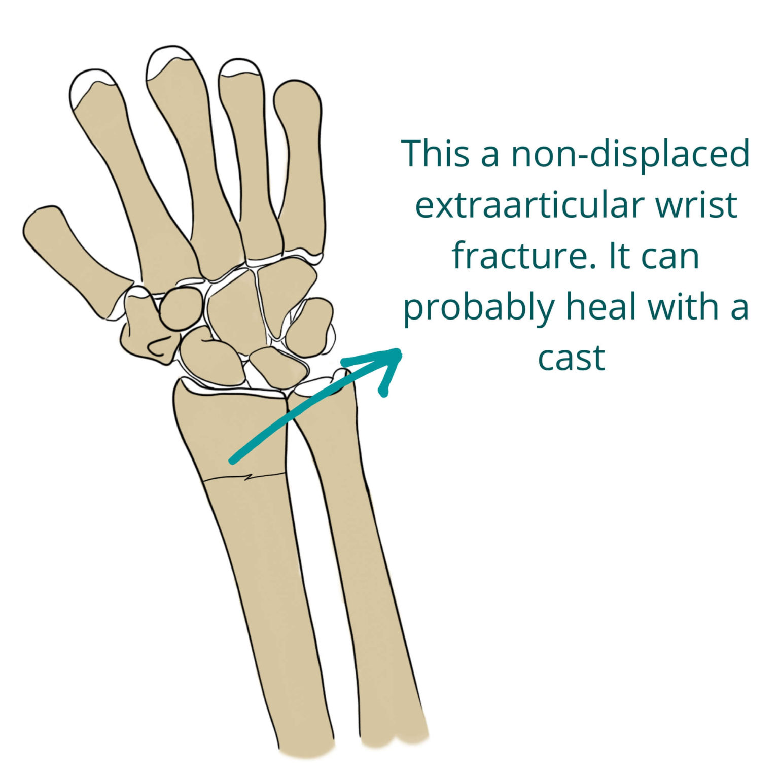non displaced distal radius fracture