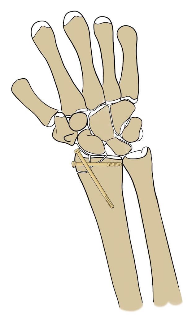 Wrist Fractures (Distal Radius Fractures) - Pro doctor