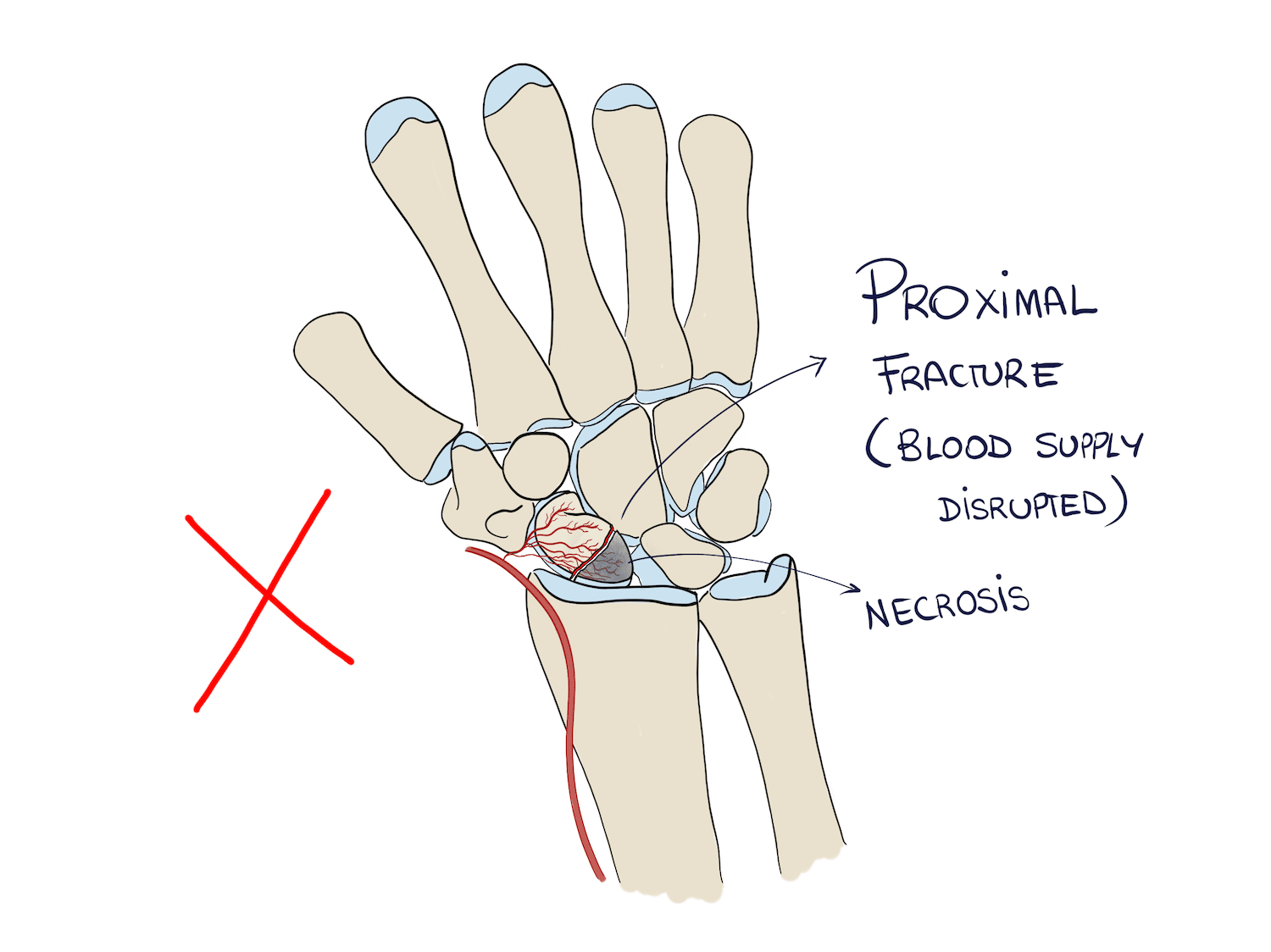 Proximal Pole Scaphoid Fracture