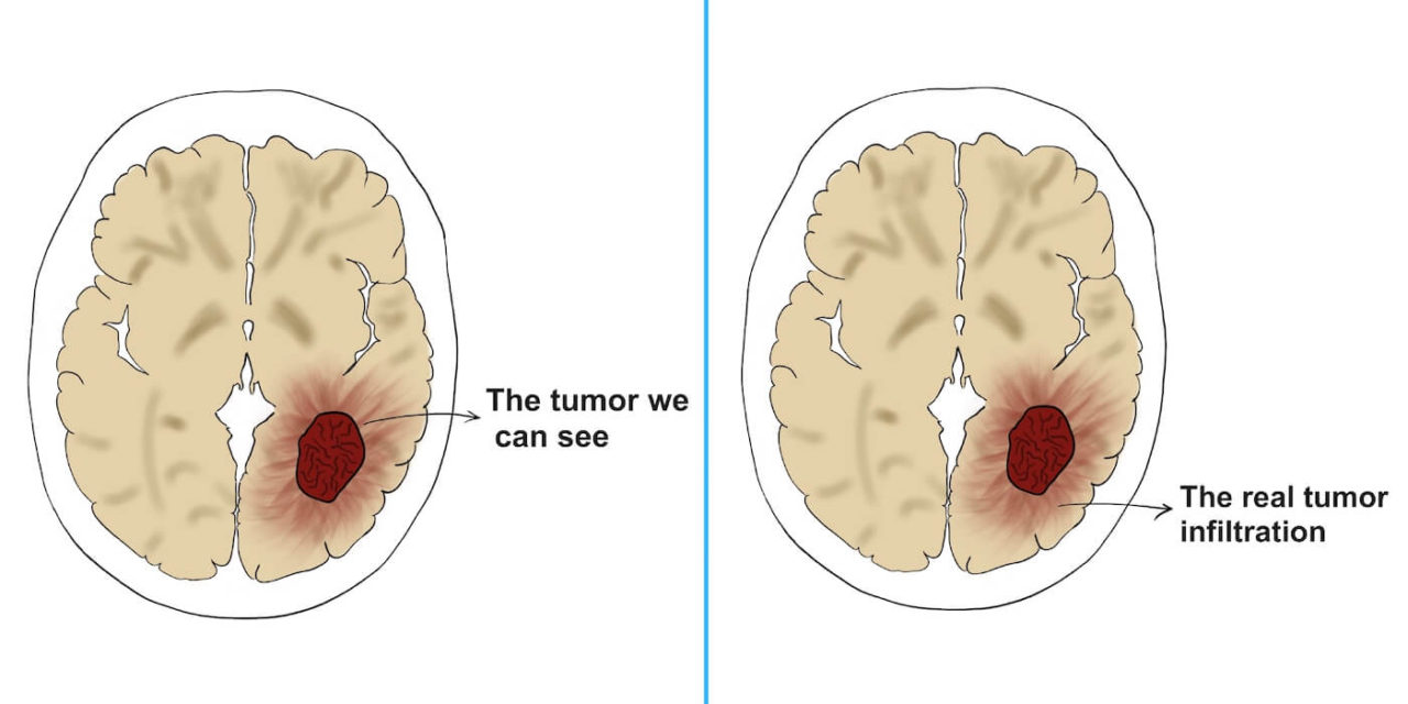 Glioblastoma Multiforme: The Deadliest Brain Tumor - Pro doctor