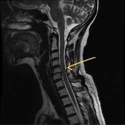 Amyotrophic Lateral Sclerosis (ALS) | The Lou Gehrig Disease - Pro doctor