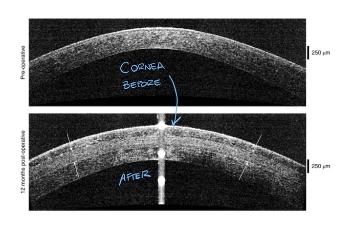 Before and after corneas