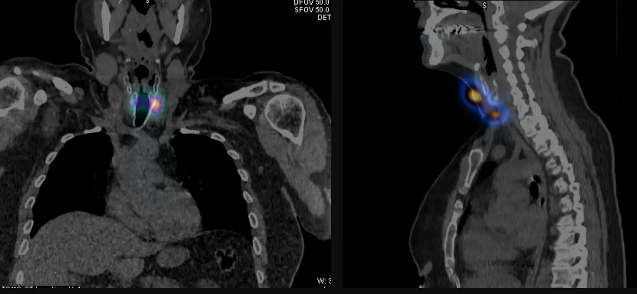 Radioiodine tracer scan