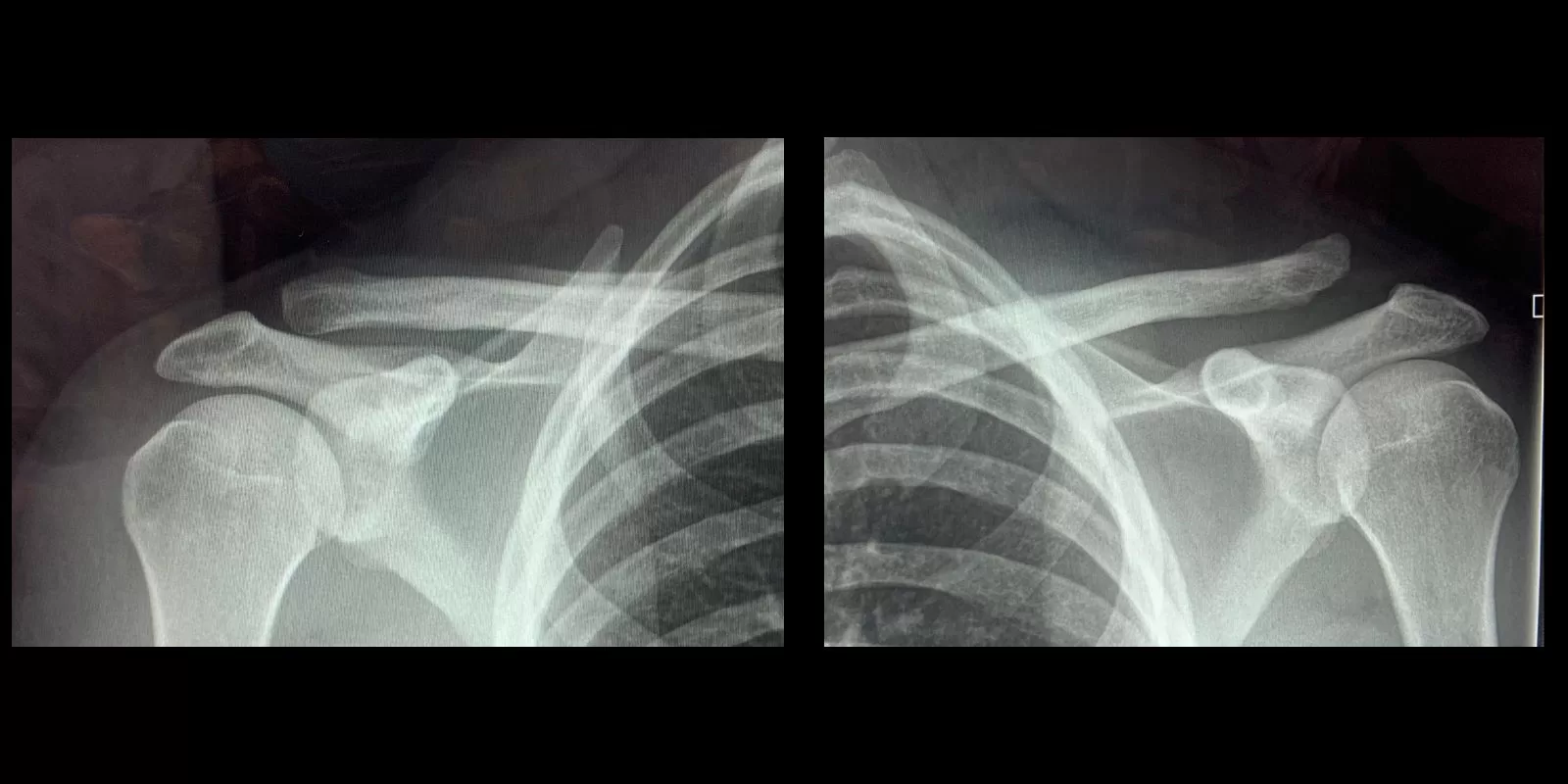 Clavicle and AC joint x-ray