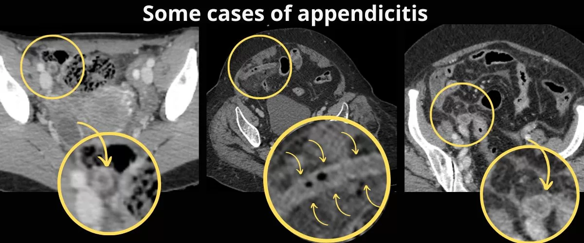 Some examples of appendicitis on CT