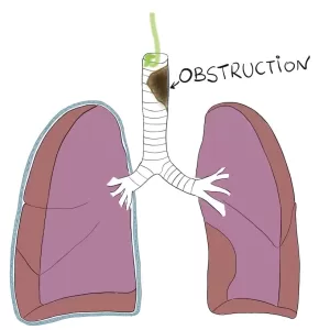 Trachea obstruction drawing