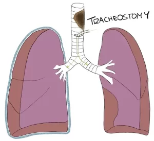 Tracheostomy drawing