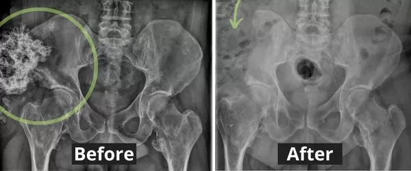 Before and after (surgery) of pelvic tumor