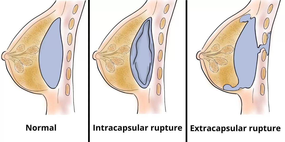 Drawing showing intracapsular vs. extracapsular drawing