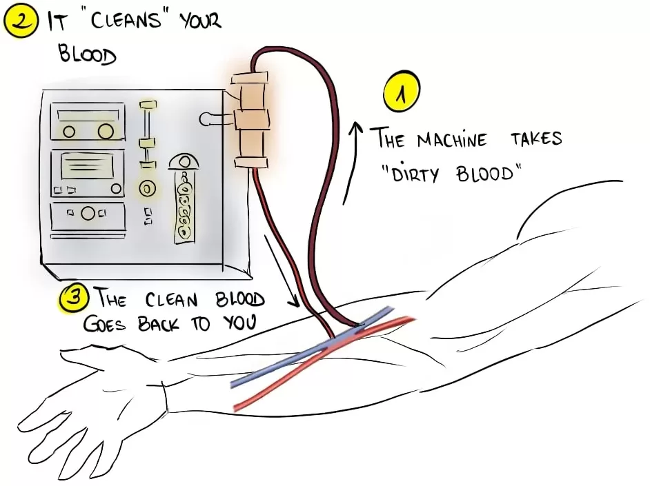 Hemodialysis machine