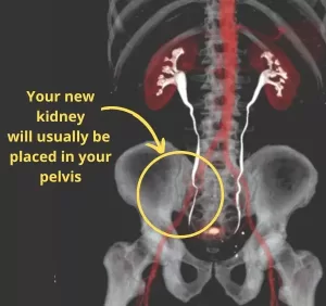 Kidney Transplant