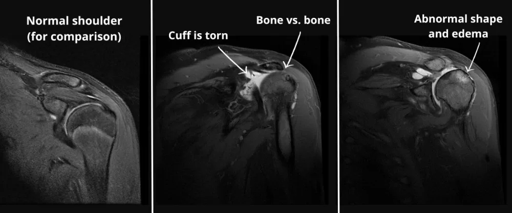 MRI massive cuff tear