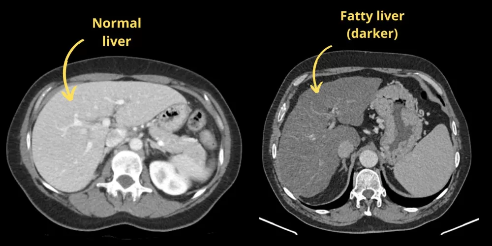 CT showing fatty liver vs. normal liver