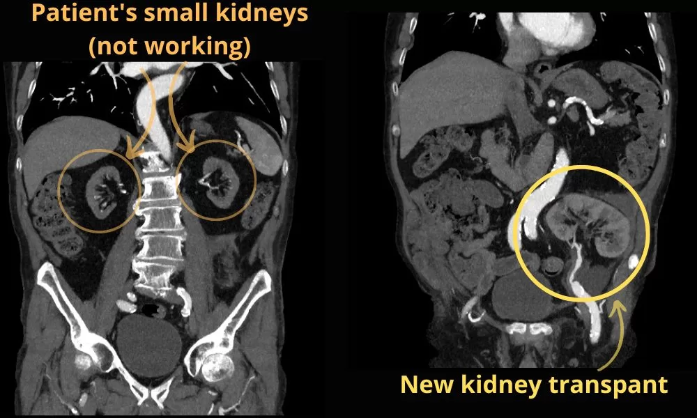 Abdomen CT showing atrophic kidneys and kidney transplant in pelvis