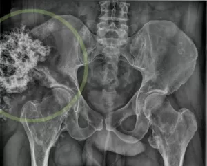 Pelvic tumor x-ray