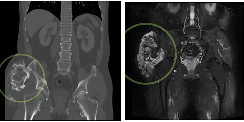 Pelvic tumor MRI and CT