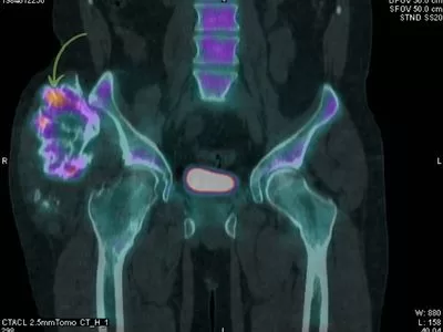 Pelvic tumor - PET CT