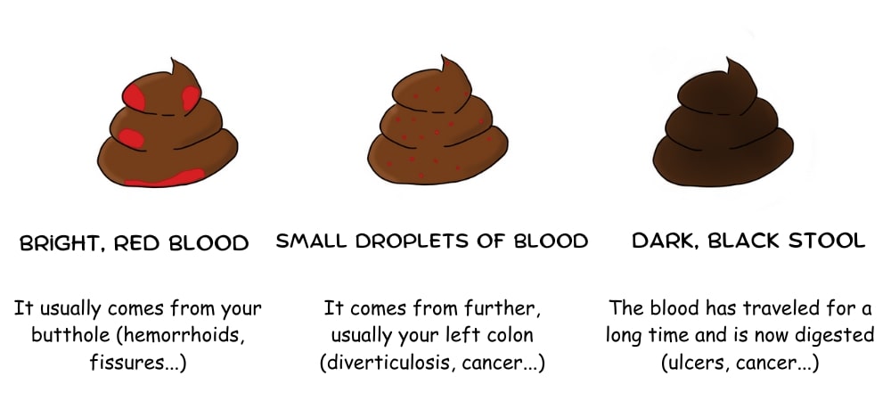 blood-in-stool-what-it-means-pro-doctor