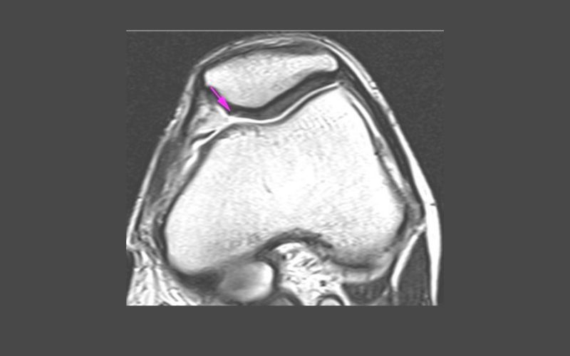 Knee Pain And Chondromalacia Patellae - Pro doctor